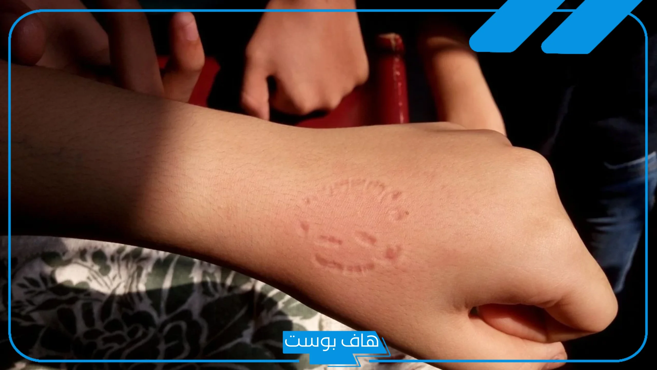 تفسير حلم العض في المنام من شخص معروف عند ابن سيرين تفسير حلم العض في المنام من شخص معروف عند ابن سيرين