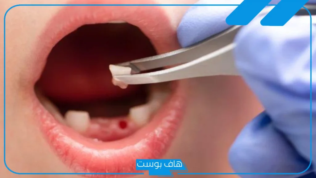 تفسير حلم سقوط السن الامامي في المنام والفك العلوي لابن سيرين