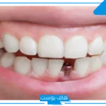 تفسير حلم سقوط السن الامامي في المنام والفك العلوي لابن سيرين