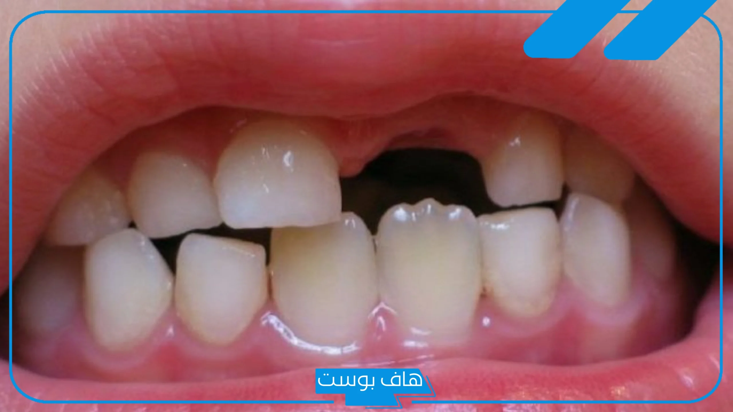 تفسير حلم سقوط سن واحد في المنام بدون ألم للمتزوجة