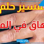 تفسير حلم البهاق في المنام للمرأة والرجل في اليد لابن سيرين