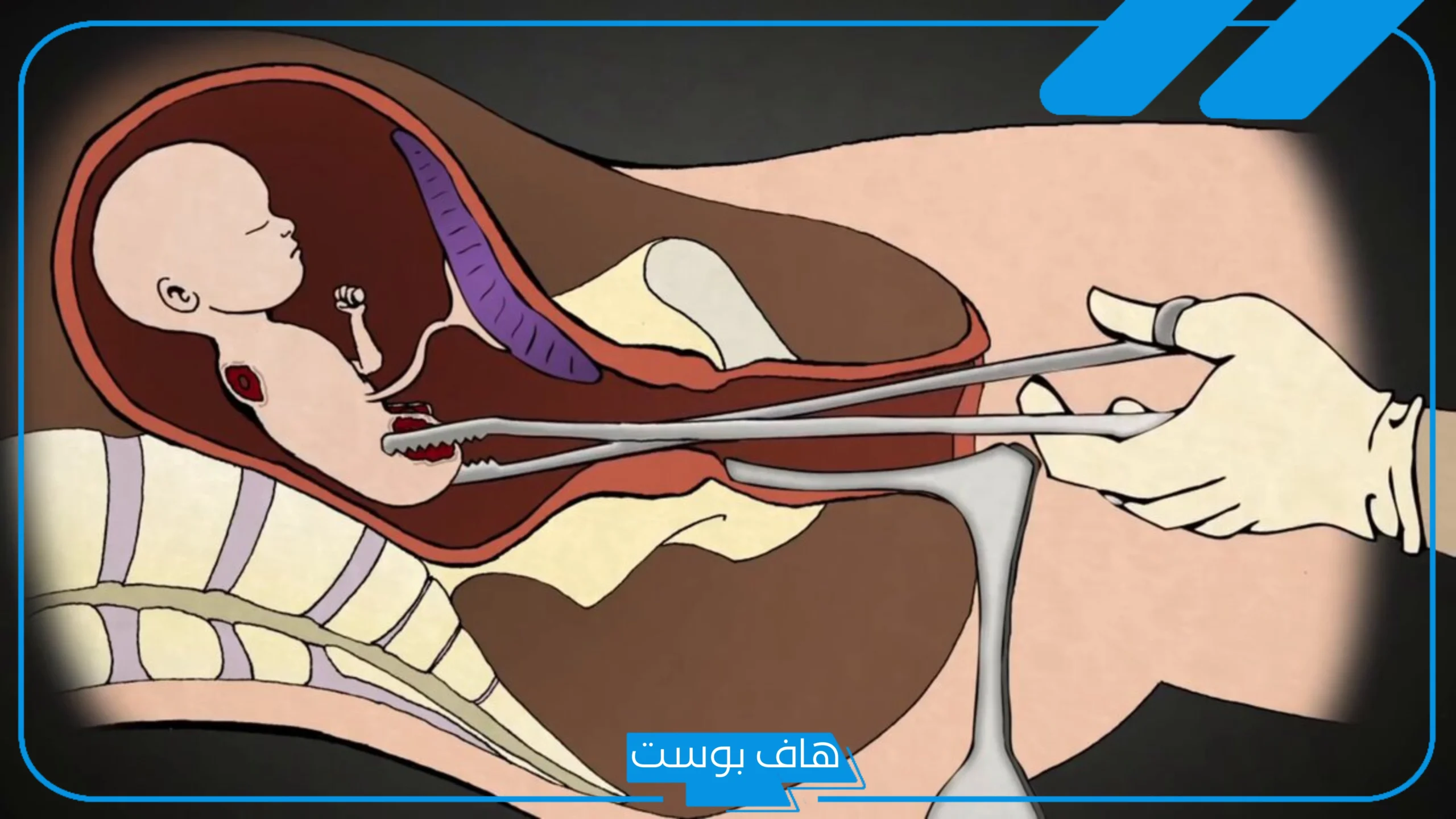 تفسير حلم الاجهاض للعزباء في المنام من حبيبها عند ابن سيرين تفسير حلم الاجهاض للعزباء في المنام من حبيبها عند ابن سيرين